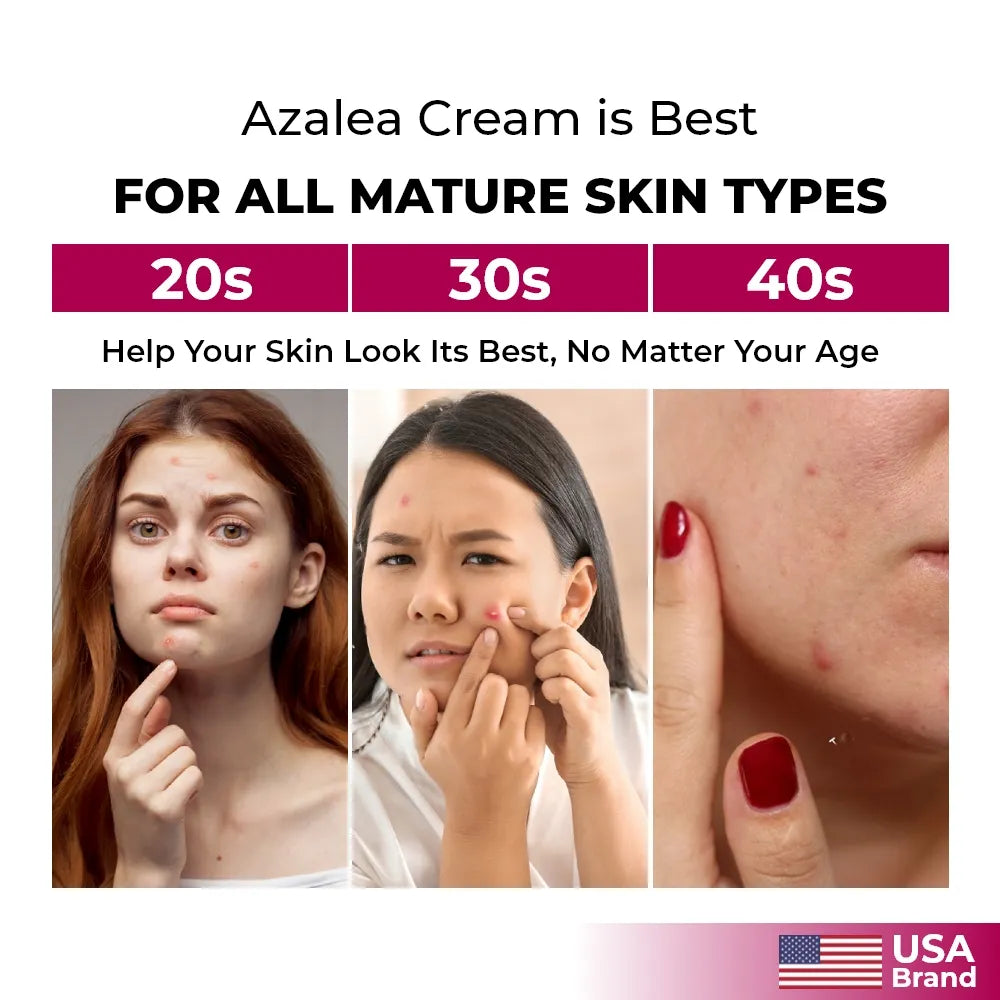 Acne Treatment Cream with Azelaic Acid – Gently Exfoliates & Brightens Skin