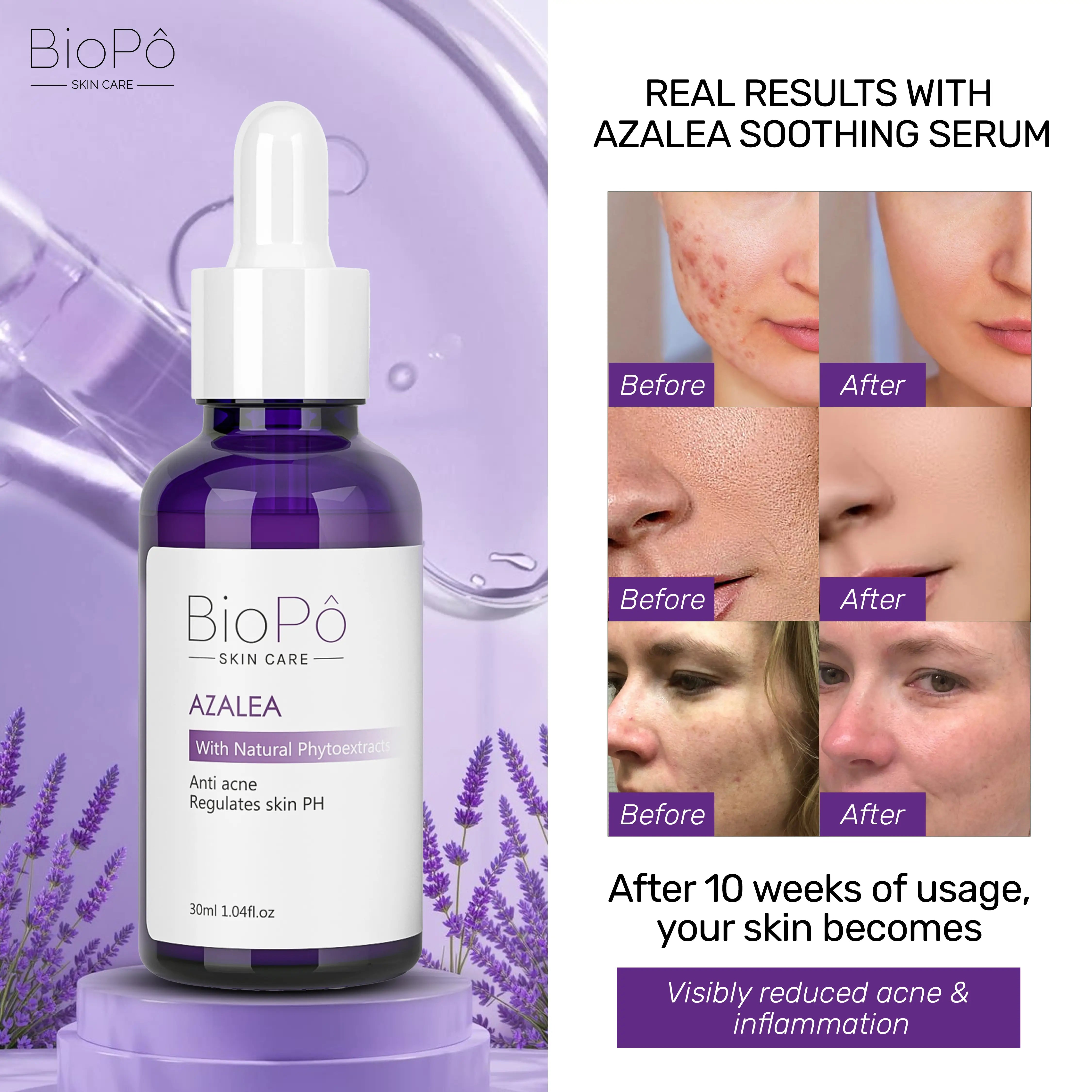 Before and after results of BioPo Azalea Acne Treatment Serum – visibly clearer, smoother, and blemish-free skin